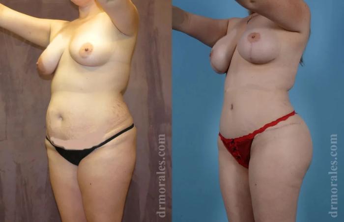 Before & After Mommy Makeover Case 260 View 1 View in Houston, TX