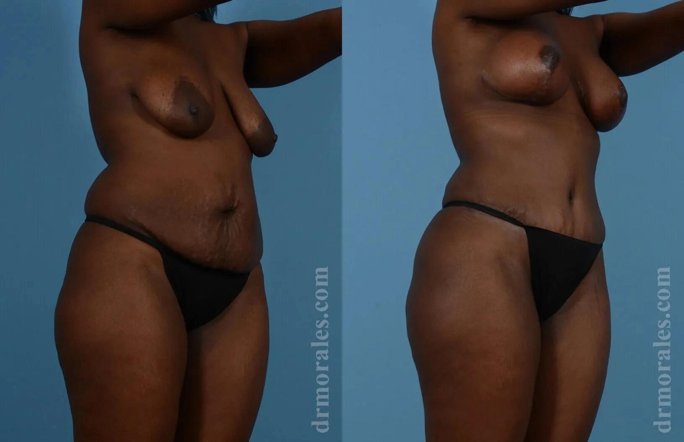 Before & After Mommy Makeover Case 261 View 1 View in Houston, TX