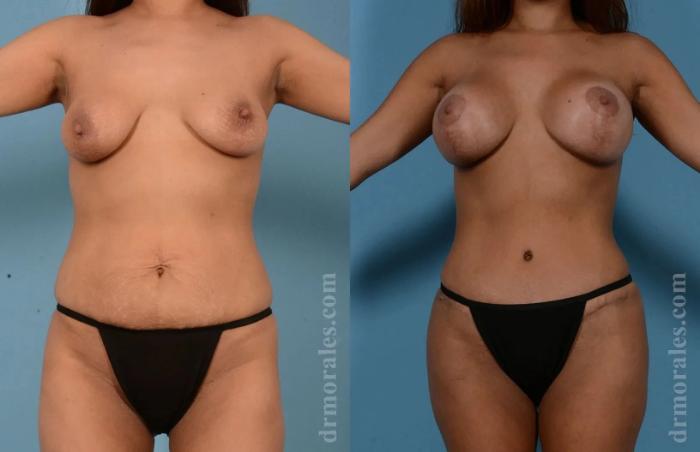 Before & After Mommy Makeover Case 262 View 1 View in Houston, TX