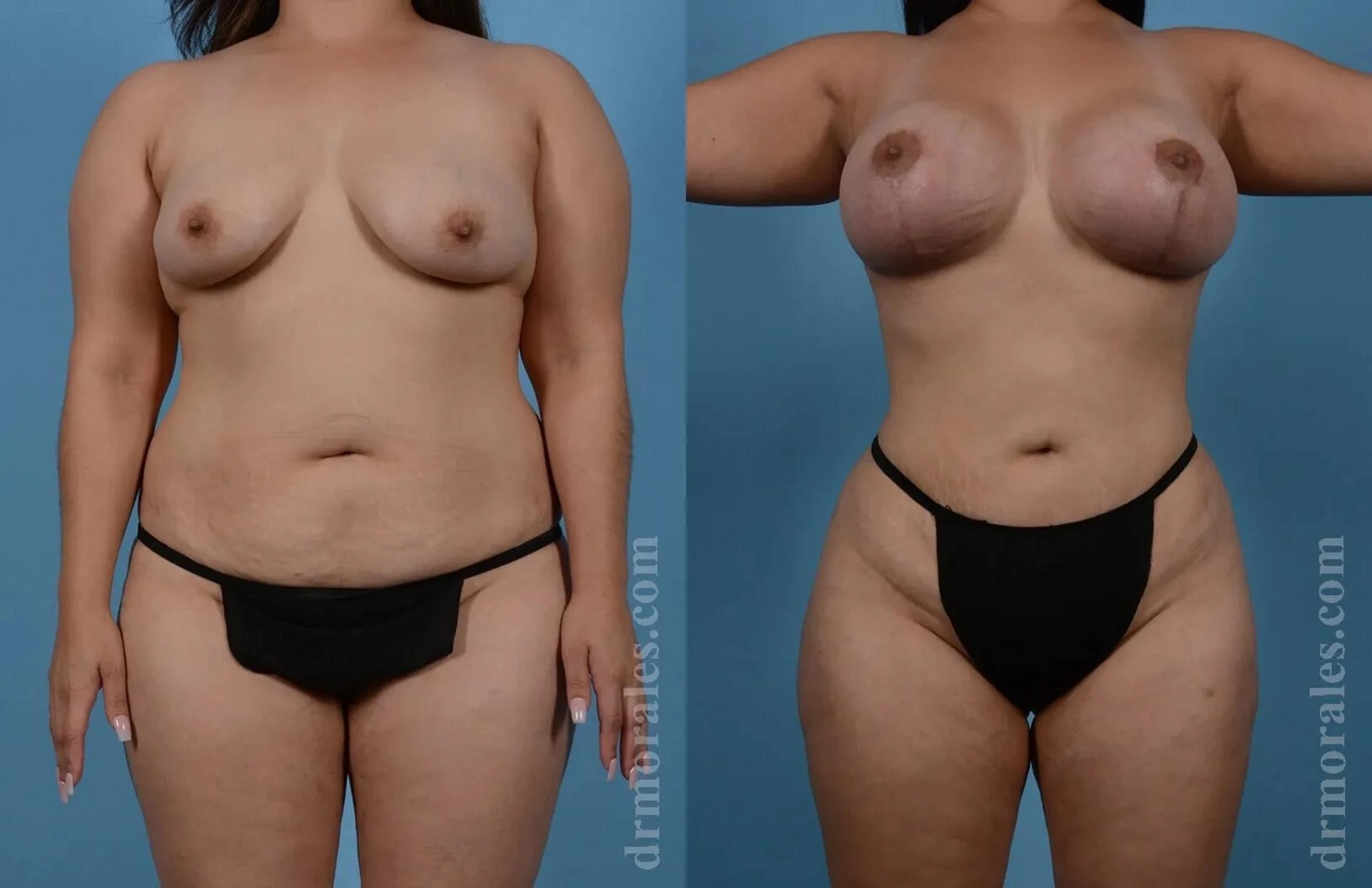 Before & After Mommy Makeover Case 263 View 1 View in Houston, TX