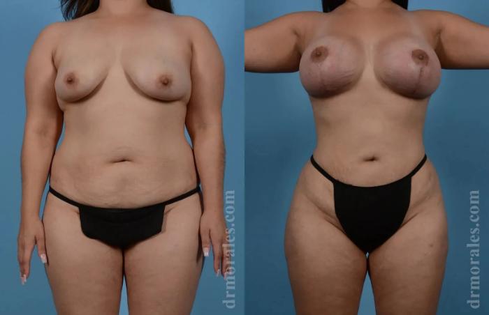 Before & After Mommy Makeover Case 263 View 1 View in Houston, TX