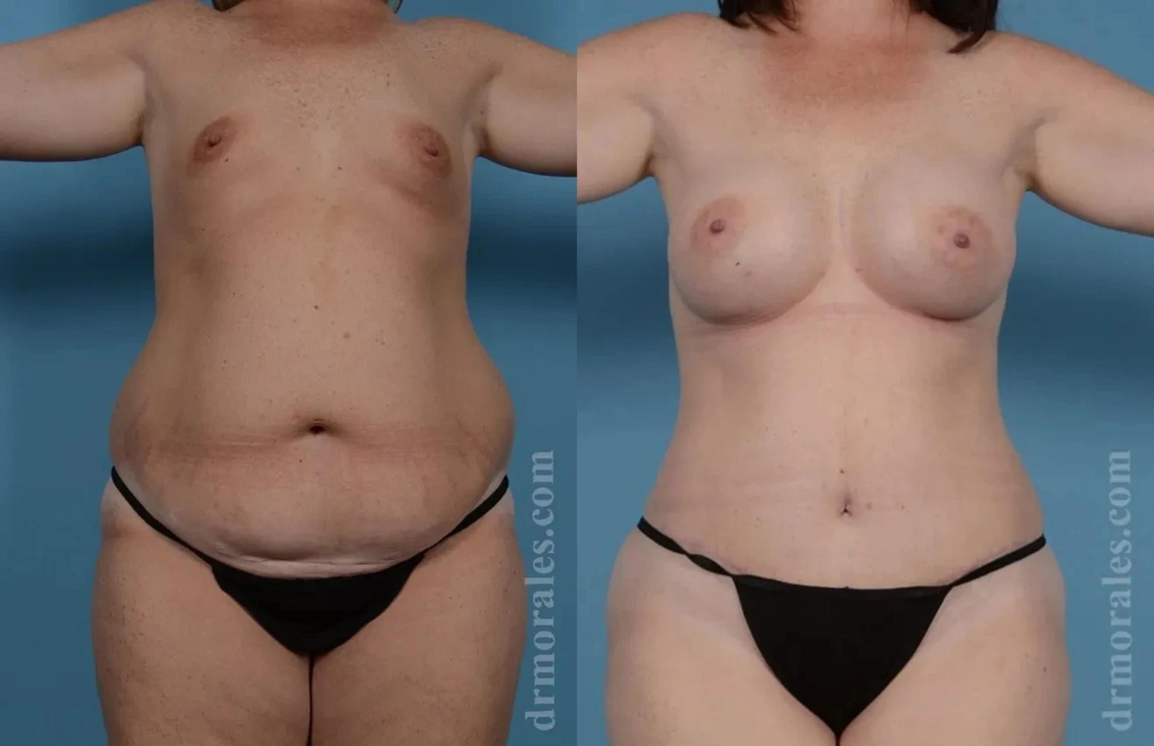 Before & After Mommy Makeover Case 264 View 1 View in Houston, TX