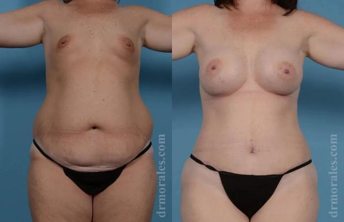 Before & After Mommy Makeover Case 264 View 1 View in Houston, TX