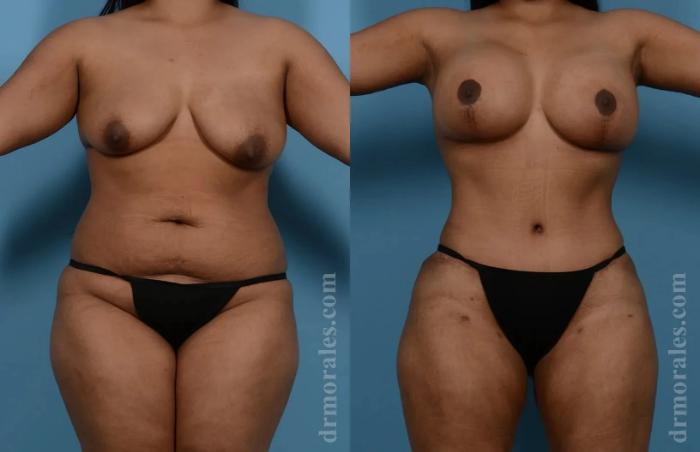 Before & After Mommy Makeover Case 267 View 1 View in Houston, TX