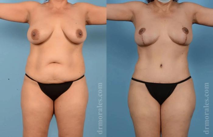 Before & After Mommy Makeover Case 268 View 1 View in Houston, TX