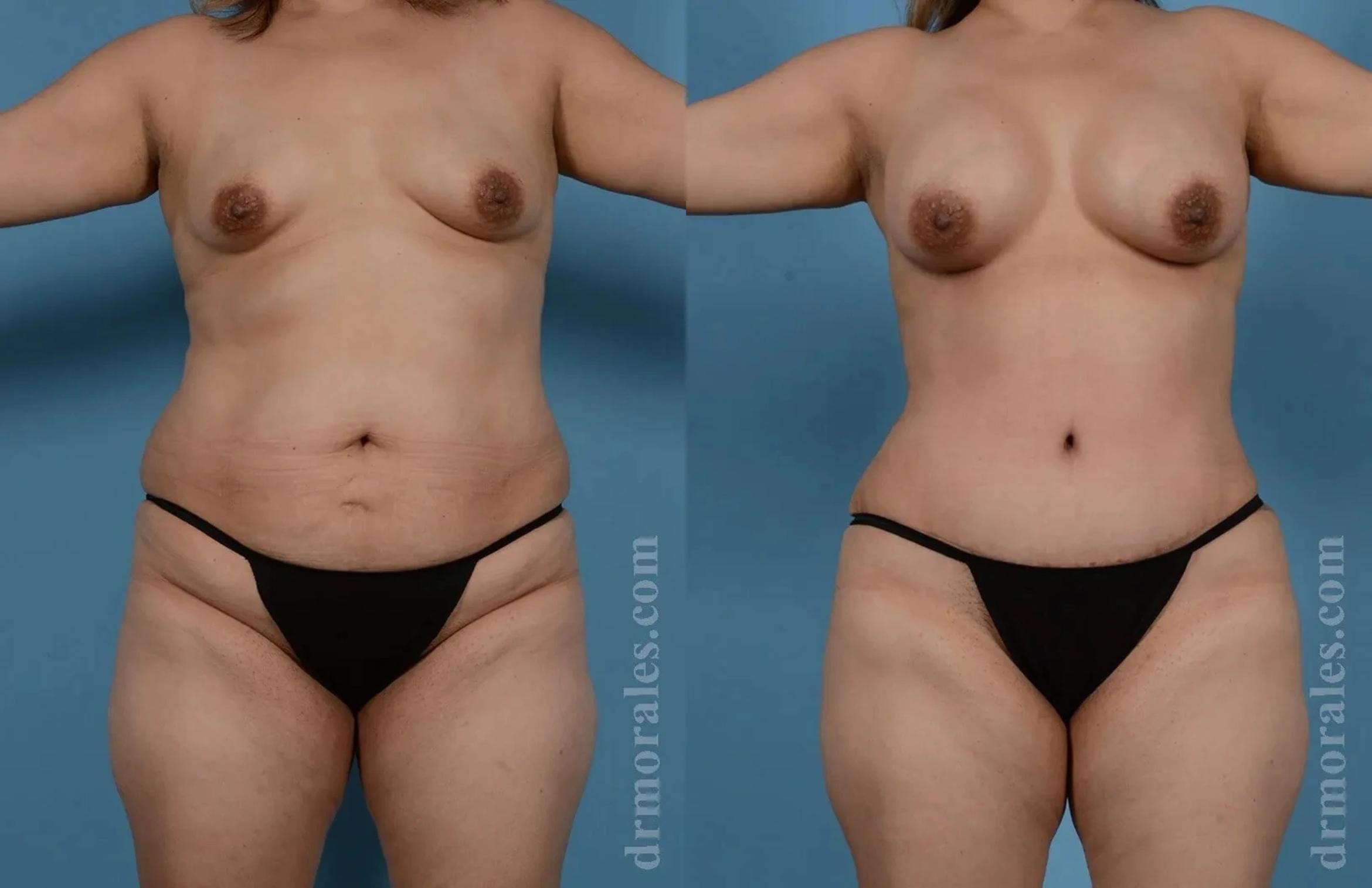 Before & After Mommy Makeover Case 270 View 1 View in Houston, TX