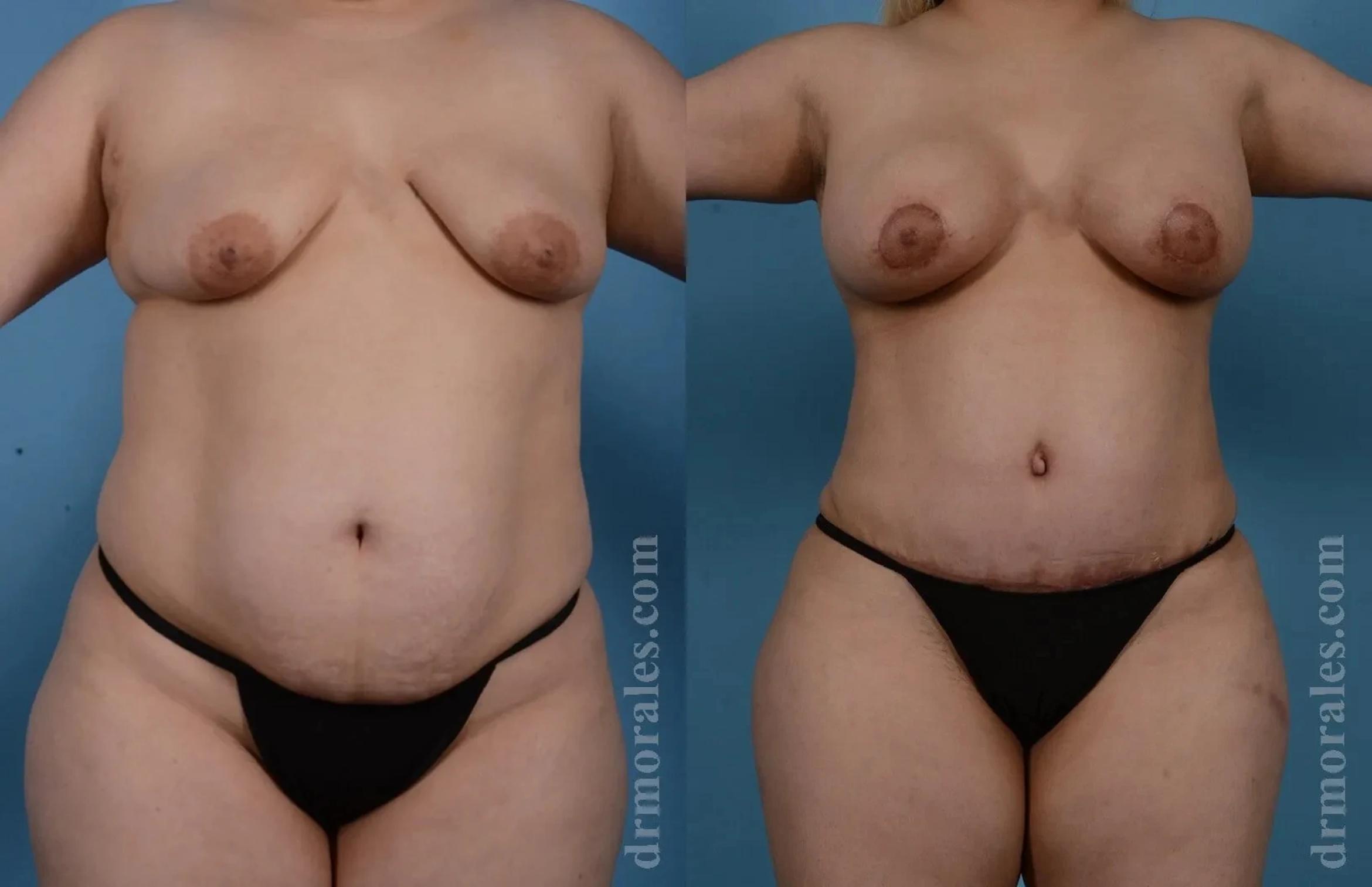 Before & After Mommy Makeover Case 271 View 1 View in Houston, TX