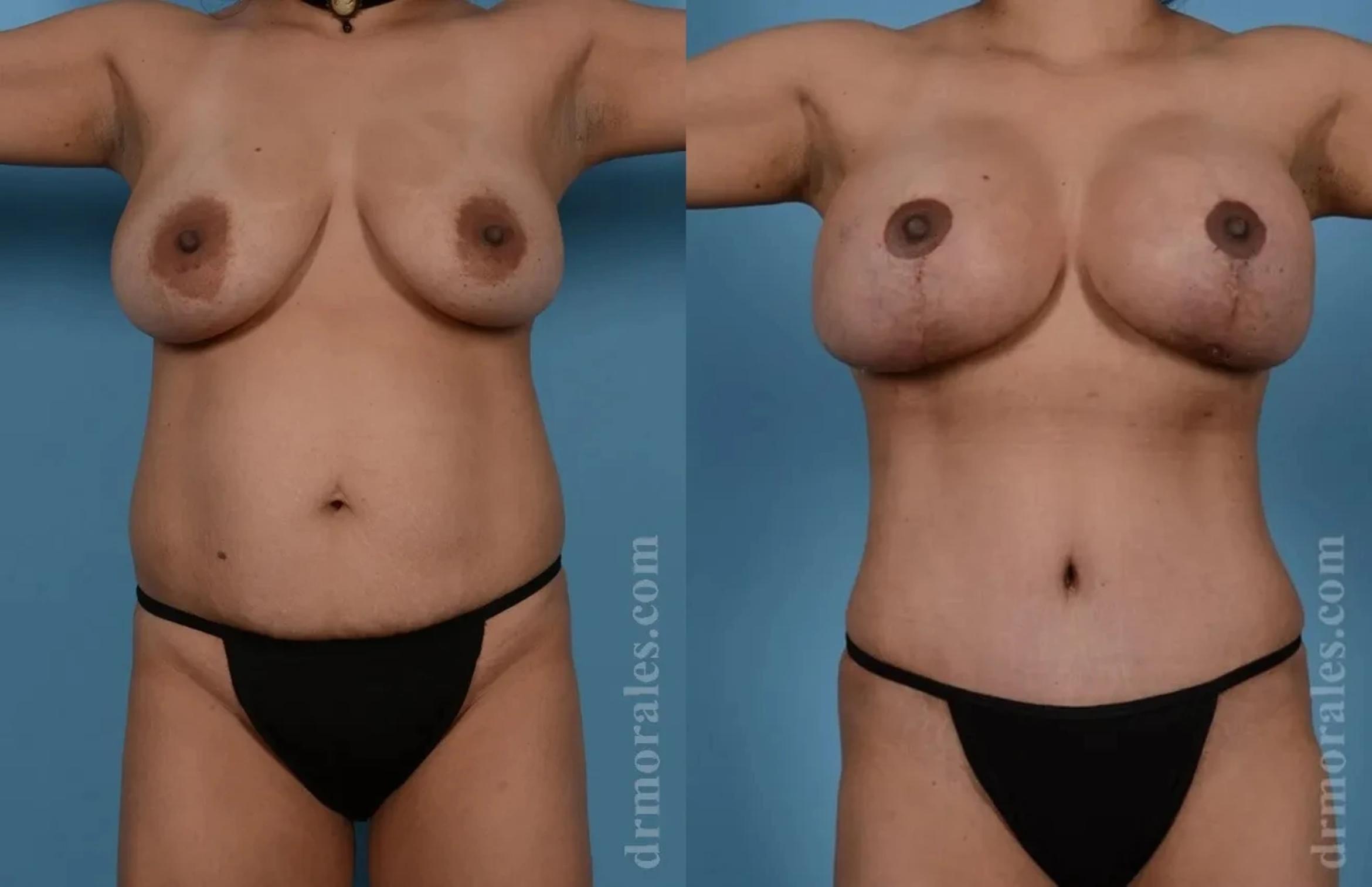 Before & After Mommy Makeover Case 272 View 1 View in Houston, TX