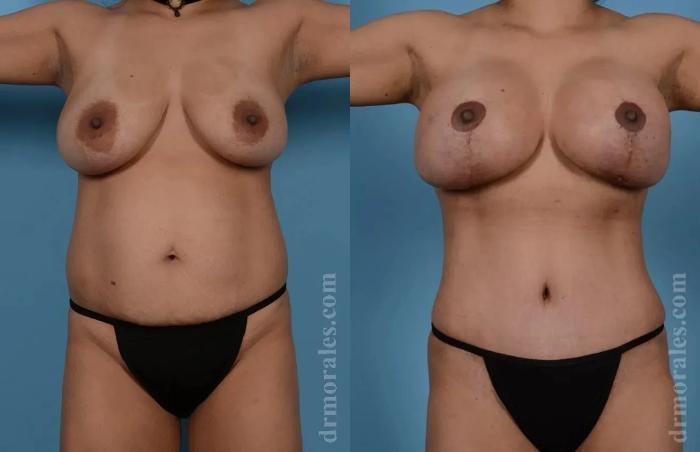 Before & After Mommy Makeover Case 272 View 1 View in Houston, TX