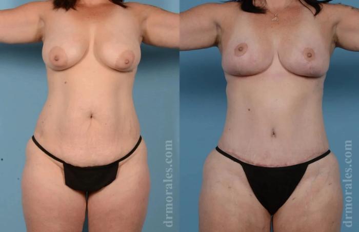 Before & After Mommy Makeover Case 273 View 1 View in Houston, TX