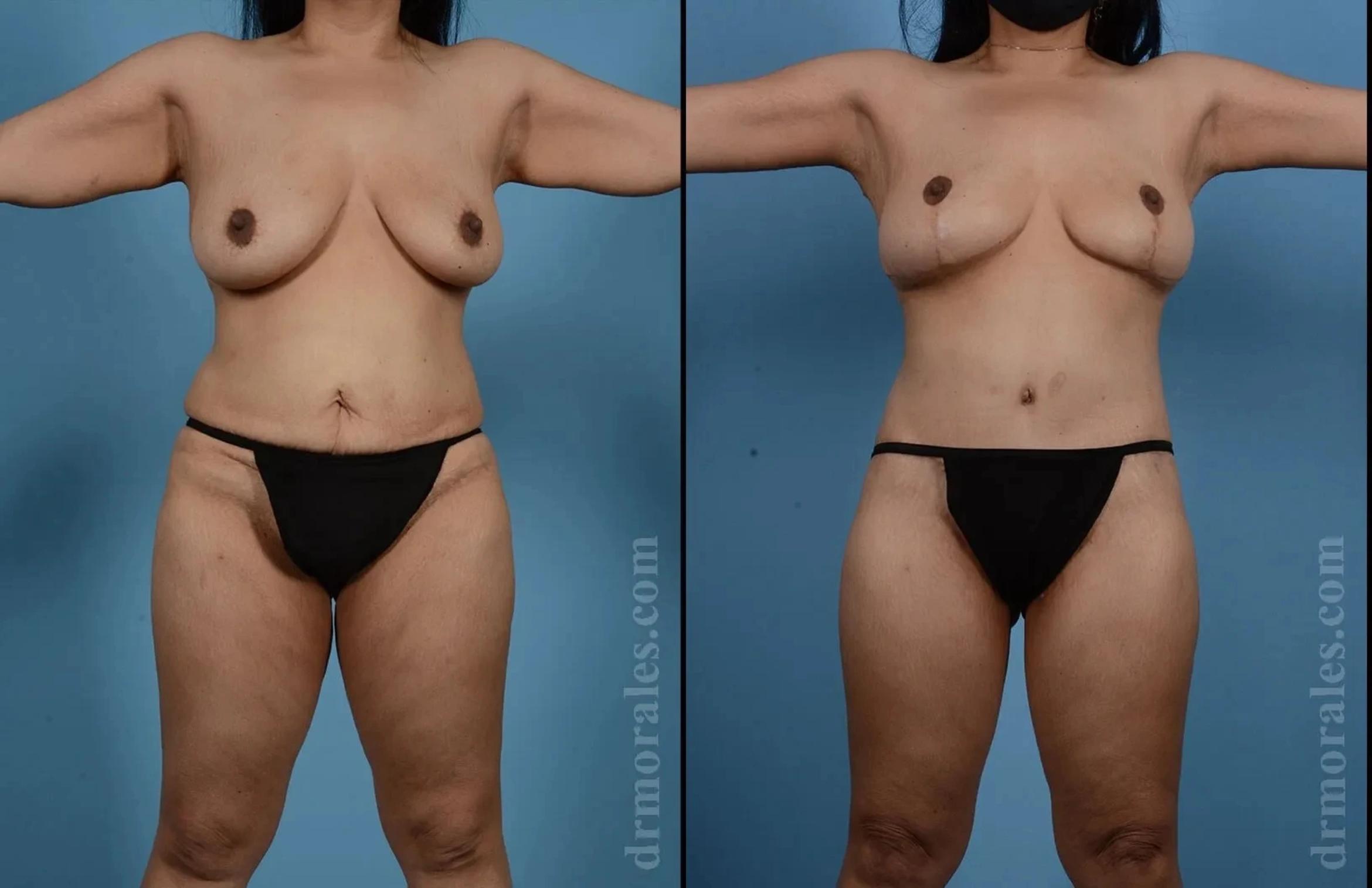 Before & After Mommy Makeover Case 275 View 1 View in Houston, TX