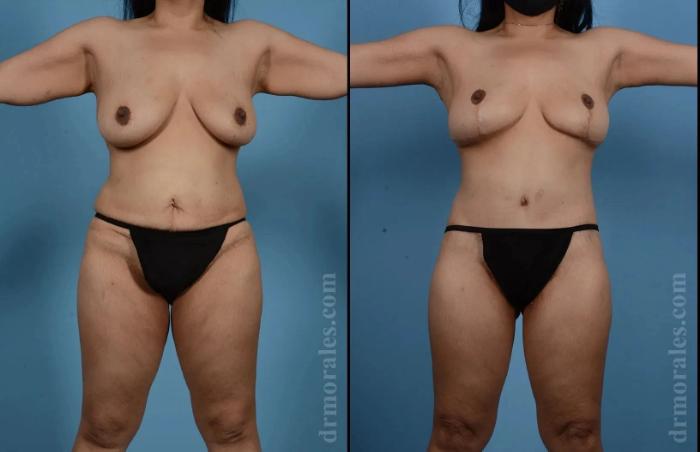 Before & After Mommy Makeover Case 275 View 1 View in Houston, TX