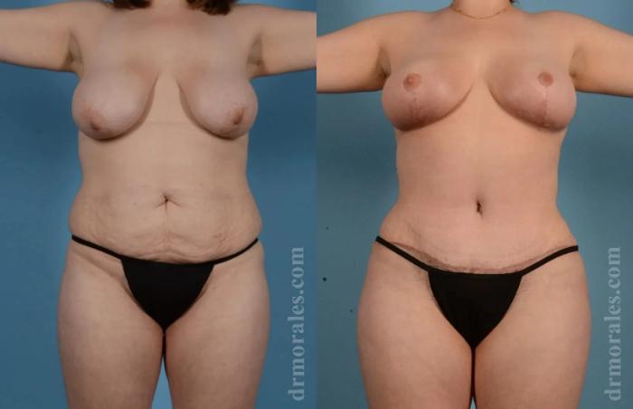 Before & After Mommy Makeover Case 276 View 1 View in Houston, TX