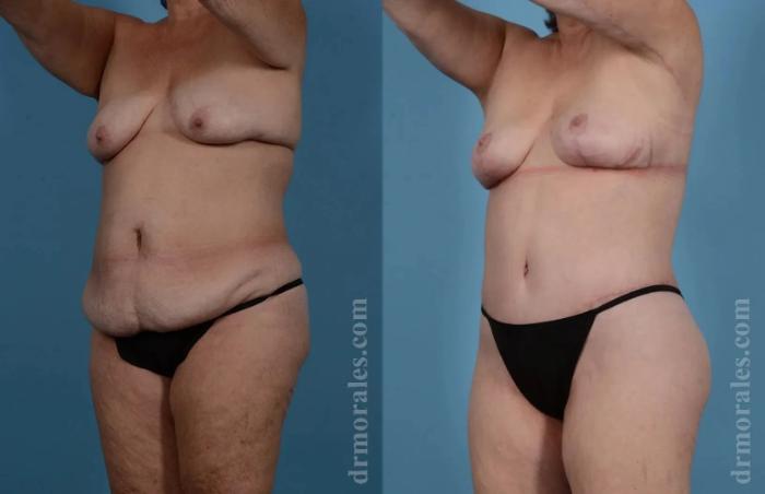 Before & After Mommy Makeover Case 278 View 1 View in Houston, TX