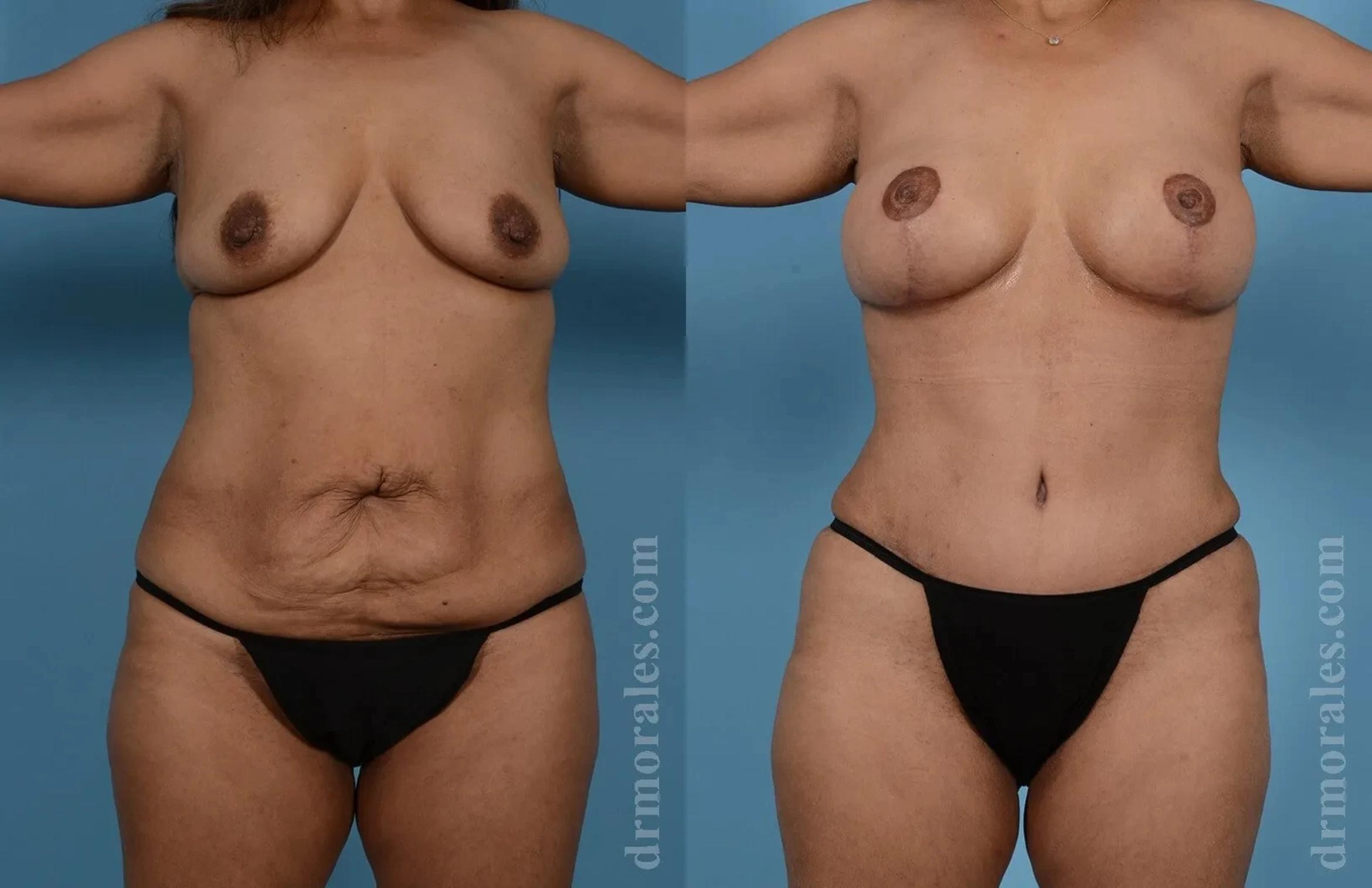 Before & After Mommy Makeover Case 279 View 1 View in Houston, TX