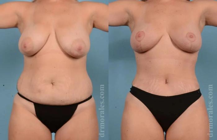 Before & After Mommy Makeover Case 280 View 1 View in Houston, TX