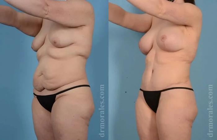 Before & After Mommy Makeover Case 281 View 1 View in Houston, TX