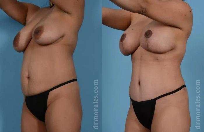 Before & After Mommy Makeover Case 282 View 1 View in Houston, TX