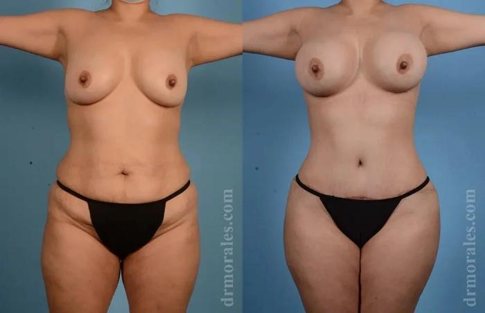 Before & After Mommy Makeover Case 283 View 1 View in Houston, TX