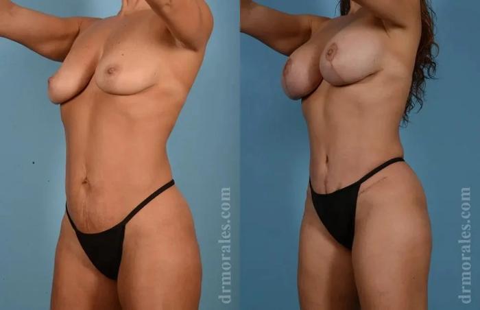 Before & After Mommy Makeover Case 284 View 1 View in Houston, TX