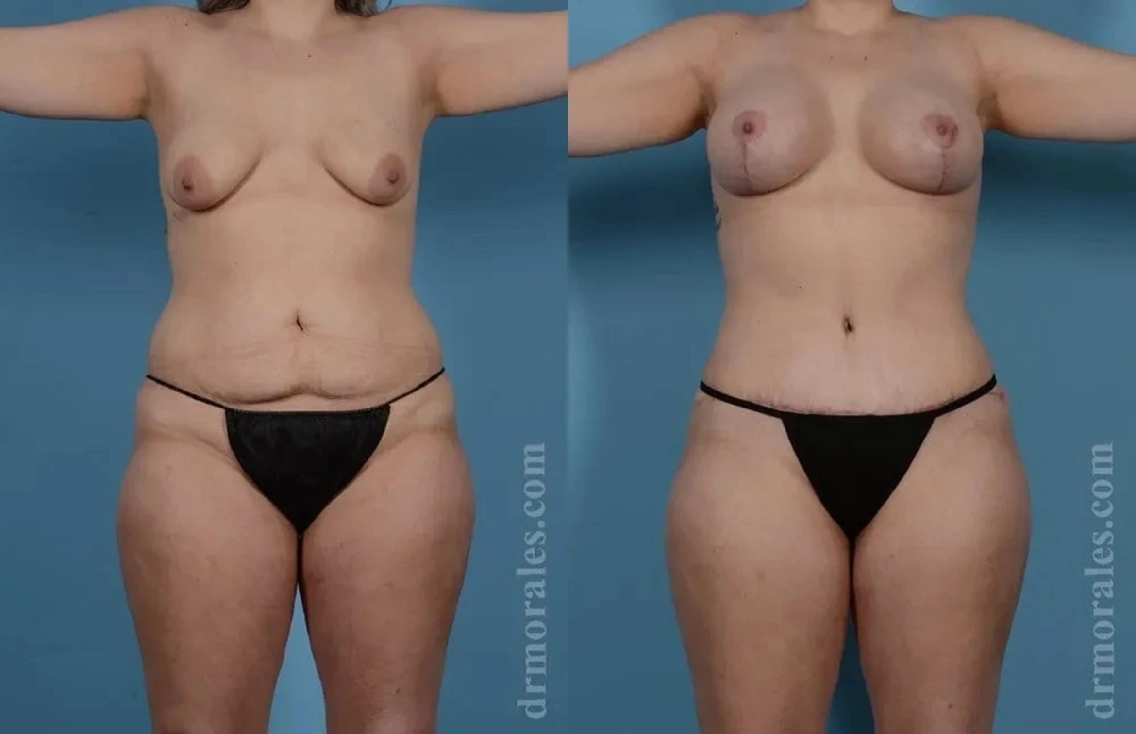 Before & After Mommy Makeover Case 285 View 1 View in Houston, TX