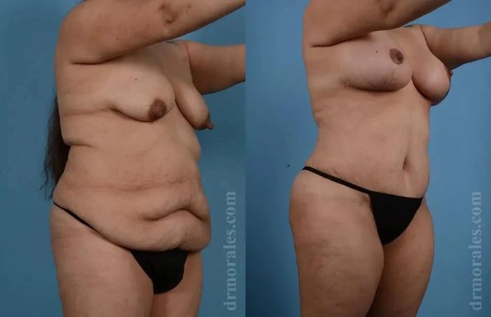 Before & After Mommy Makeover Case 286 View 1 View in Houston, TX