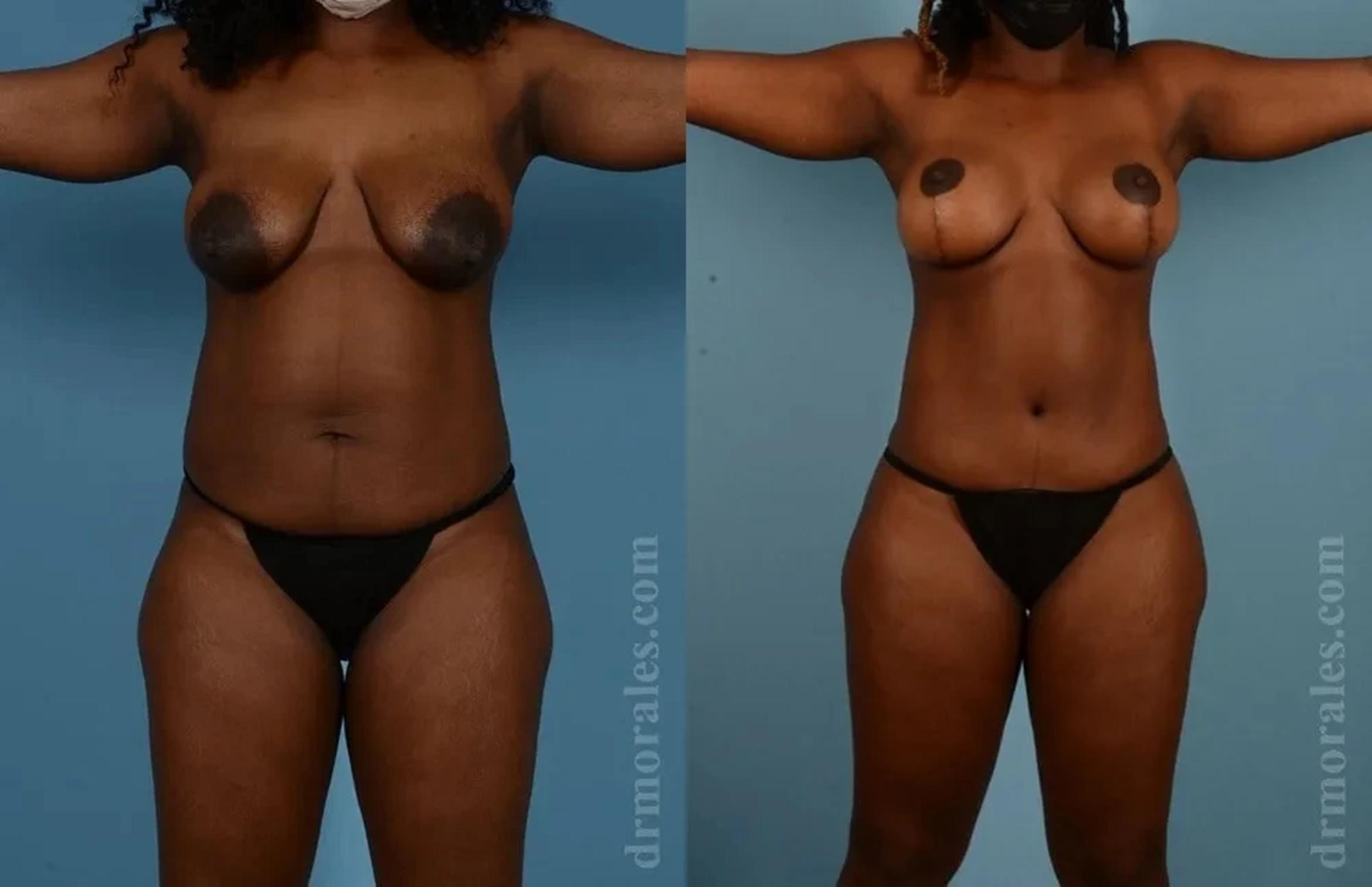 Before & After Mommy Makeover Case 287 View 1 View in Houston, TX