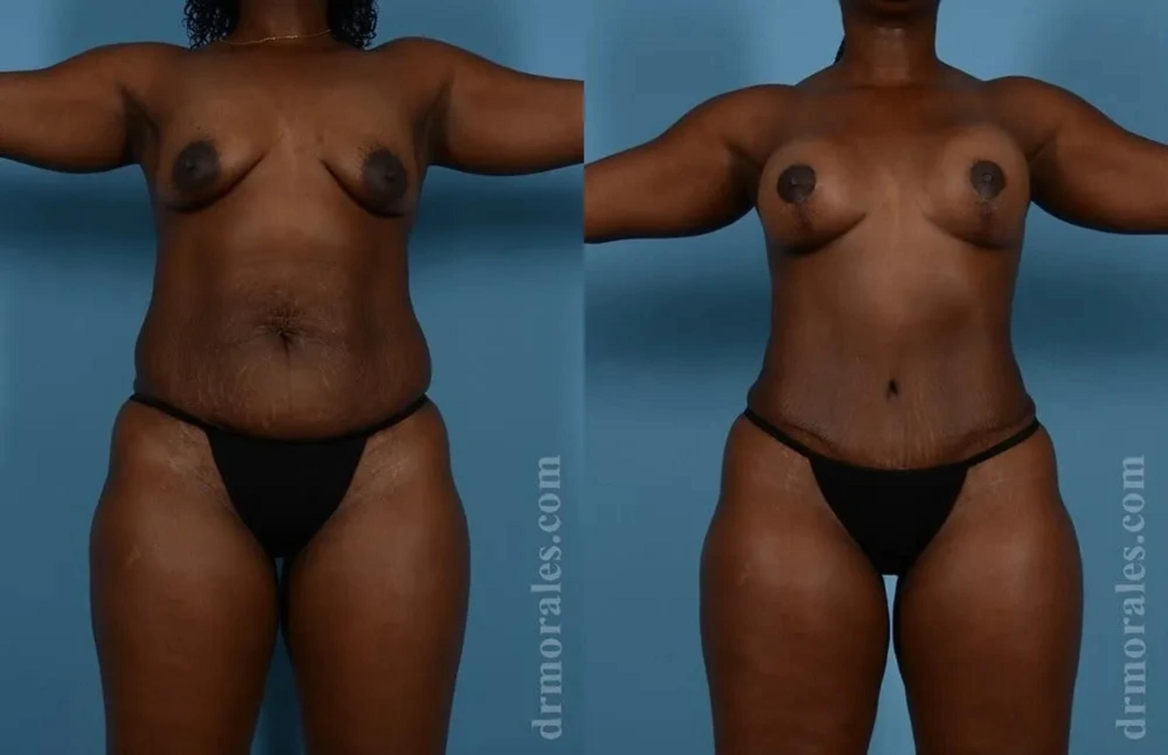 Before & After Mommy Makeover Case 288 View 1 View in Houston, TX