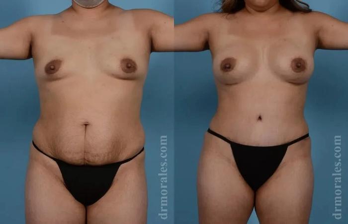 Before & After Mommy Makeover Case 289 View 1 View in Houston, TX