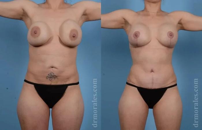 Before & After Mommy Makeover Case 290 View 1 View in Houston, TX