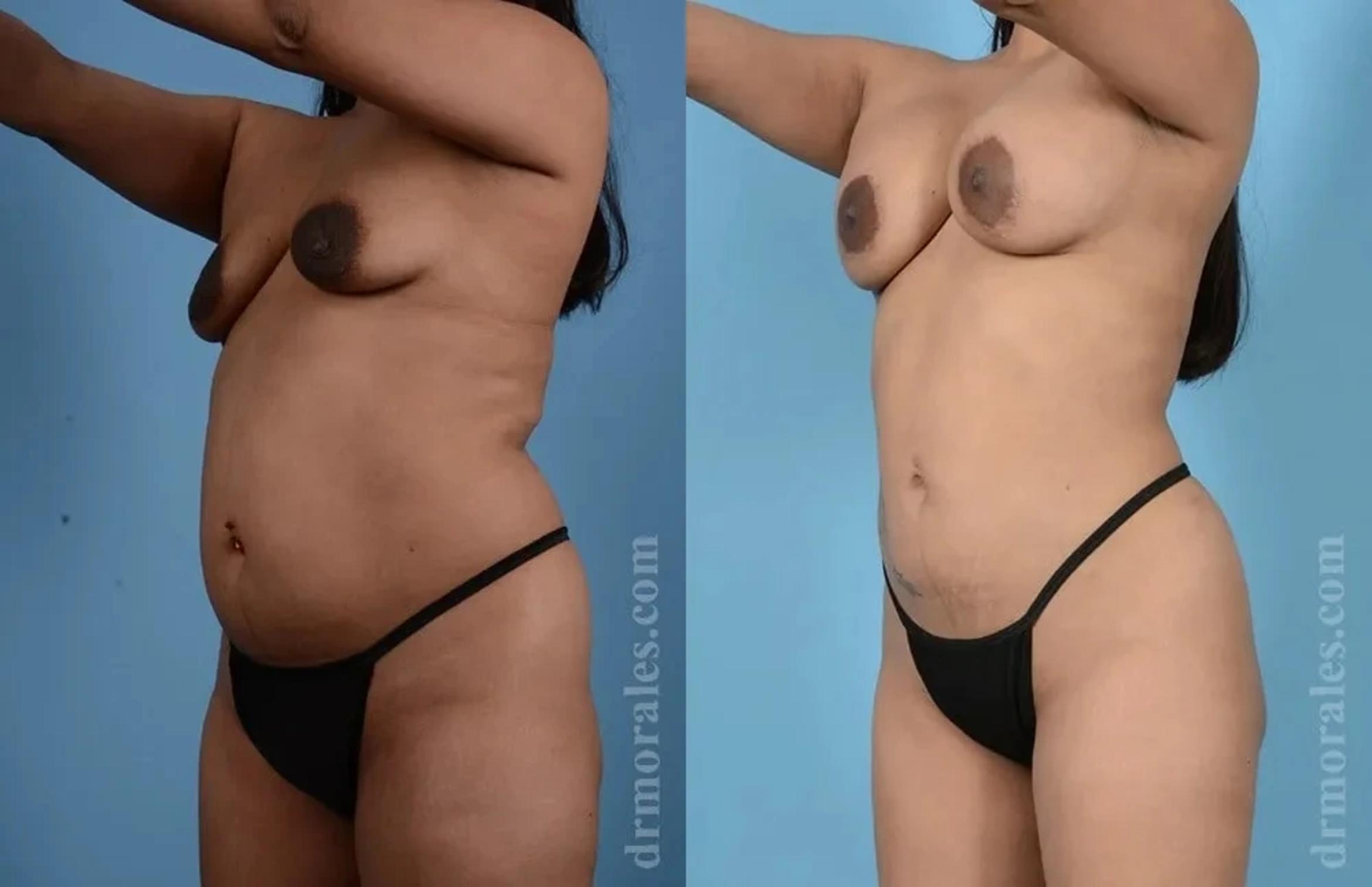 Before & After Mommy Makeover Case 291 View 1 View in Houston, TX