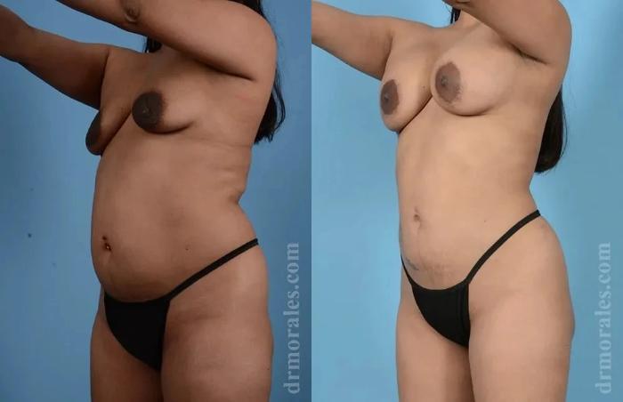 Before & After Mommy Makeover Case 291 View 1 View in Houston, TX