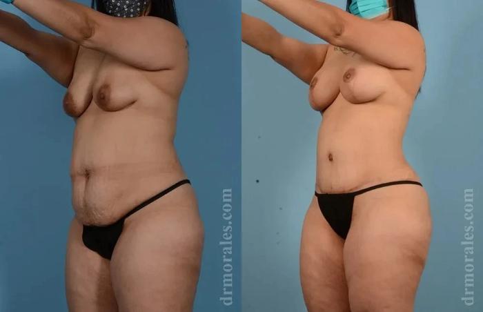 Before & After Mommy Makeover Case 292 View 1 View in Houston, TX