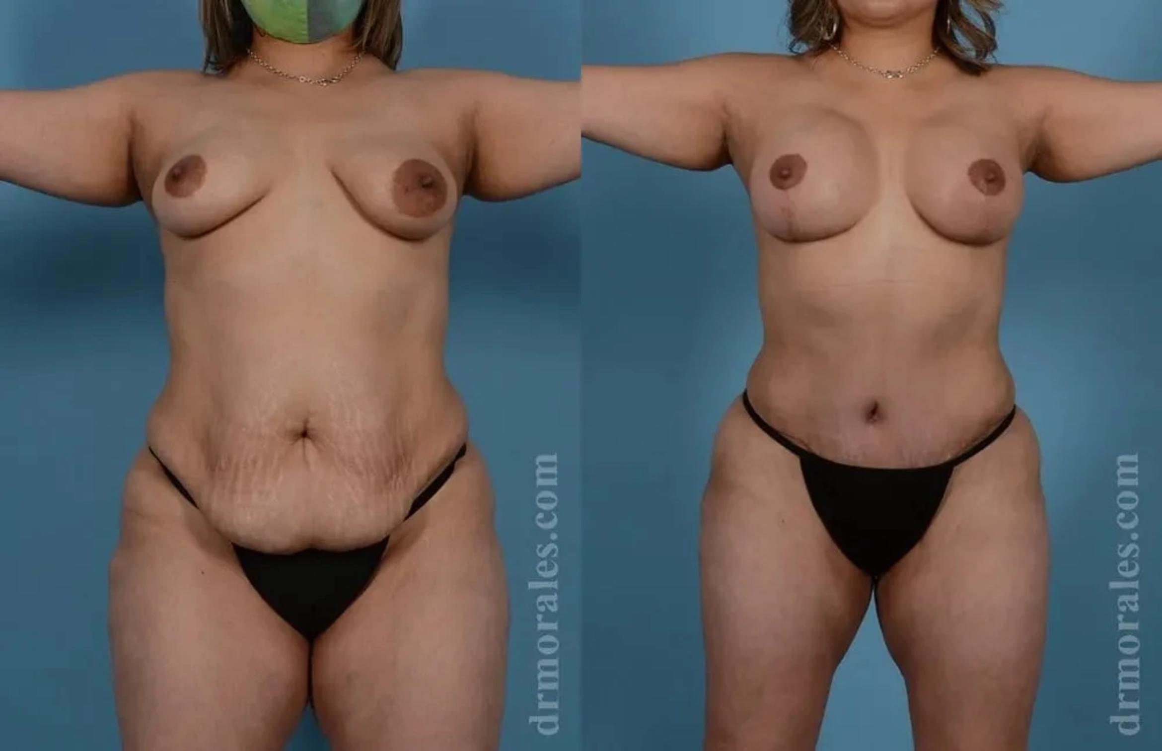 Before & After Mommy Makeover Case 293 View 1 View in Houston, TX