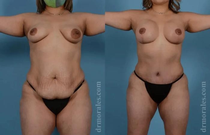 Before & After Mommy Makeover Case 293 View 1 View in Houston, TX