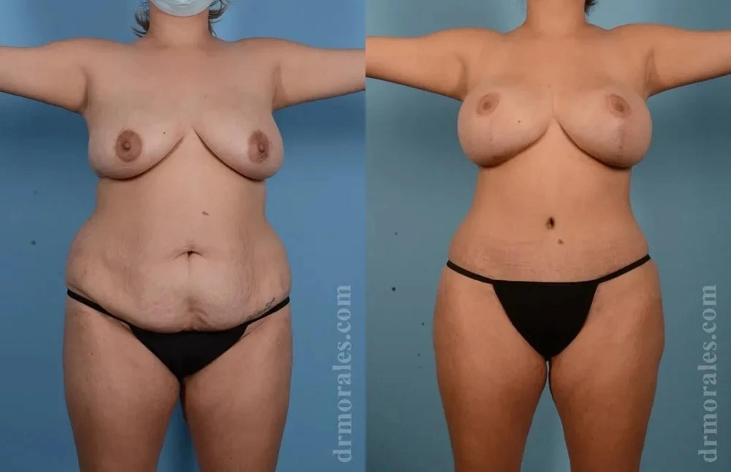 Before & After Mommy Makeover Case 294 View 1 View in Houston, TX