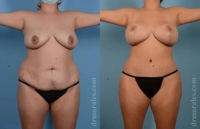 Before & After Mommy Makeover Case 294 View 1 View in Houston, TX