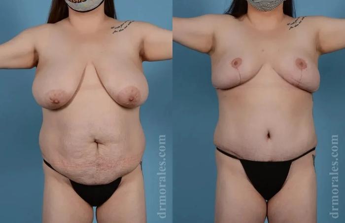 Before & After Mommy Makeover Case 295 View 1 View in Houston, TX