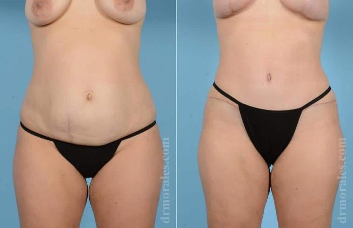 Before & After Mommy Makeover Case 44 View 1 View in Houston, TX