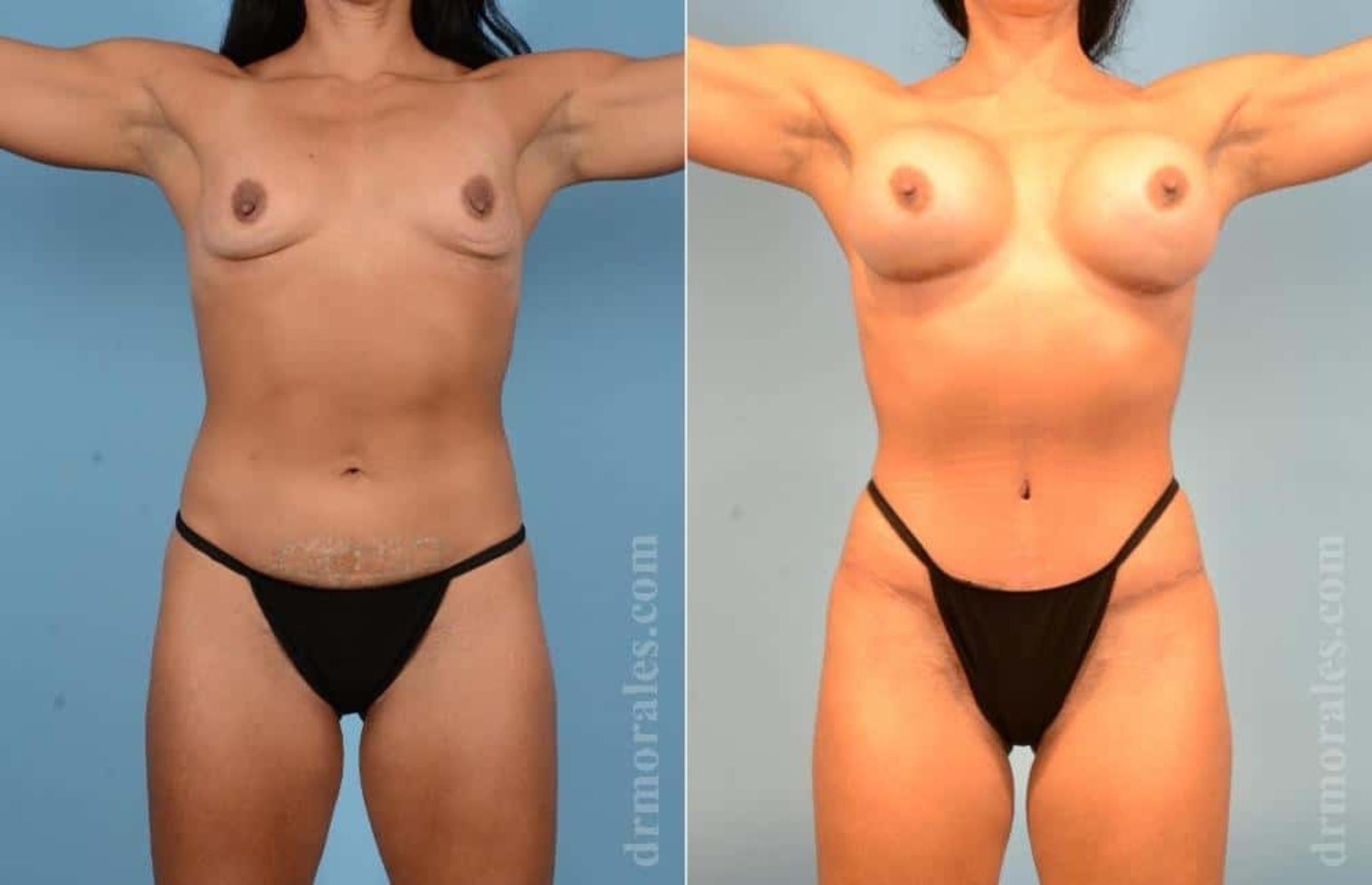 Before & After Mommy Makeover Case 53 View 1 View in Houston, TX