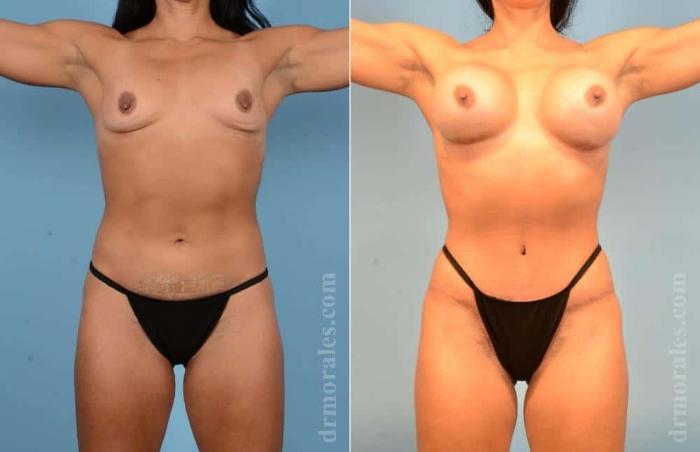 Before & After Mommy Makeover Case 53 View 1 View in Houston, TX