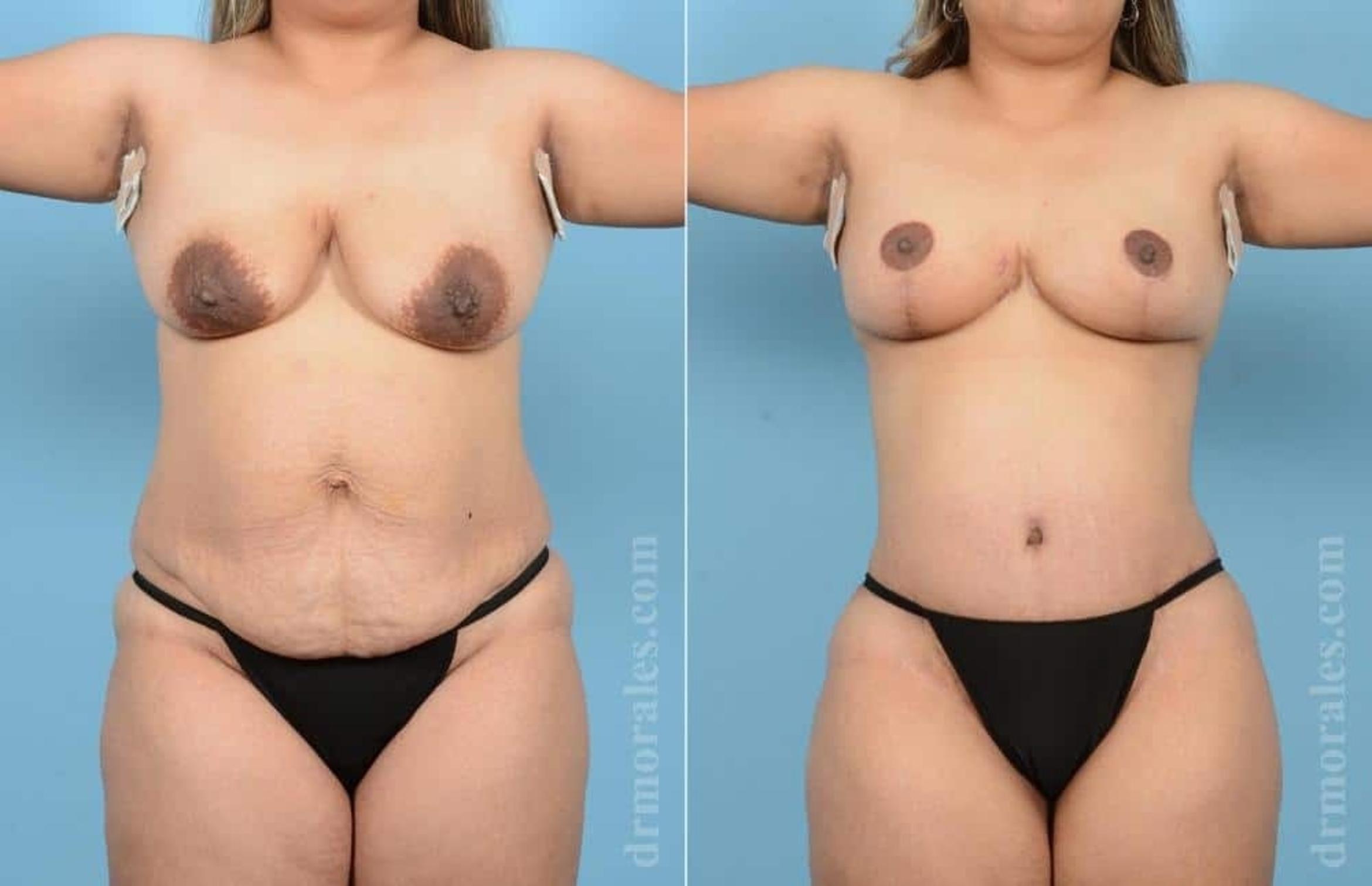 Before & After Mommy Makeover Case 54 View 1 View in Houston, TX