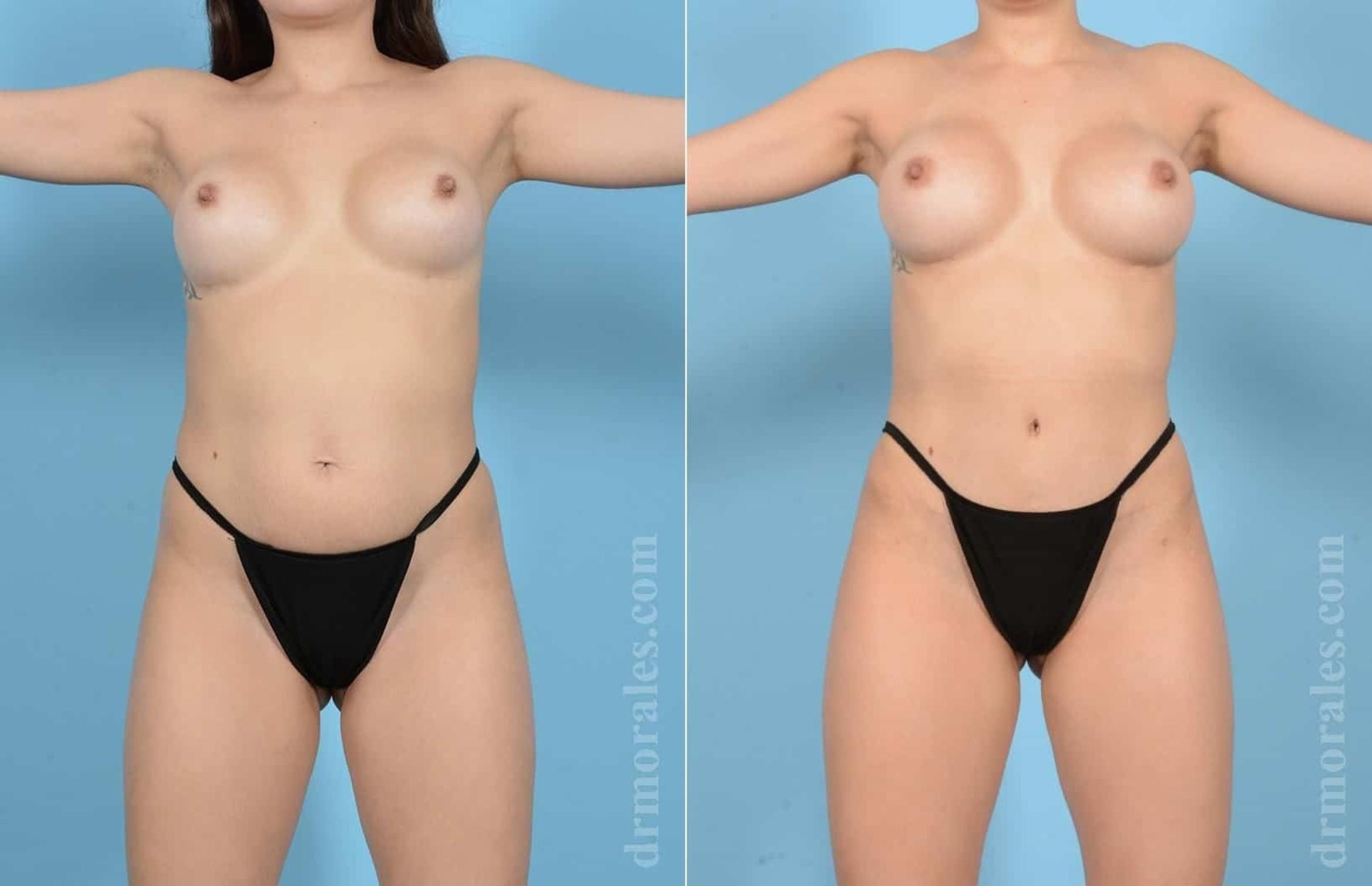 Before & After Mommy Makeover Case 56 View 1 View in Houston, TX