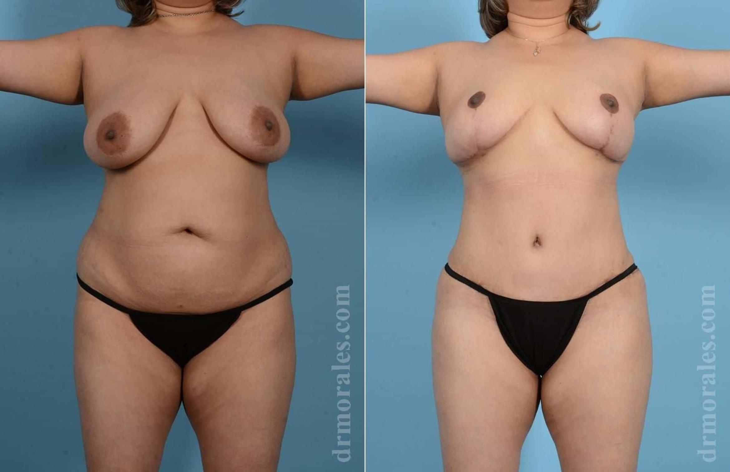 Before & After Mommy Makeover Case 57 View 1 View in Houston, TX