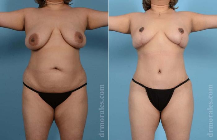 Before & After Mommy Makeover Case 57 View 1 View in Houston, TX