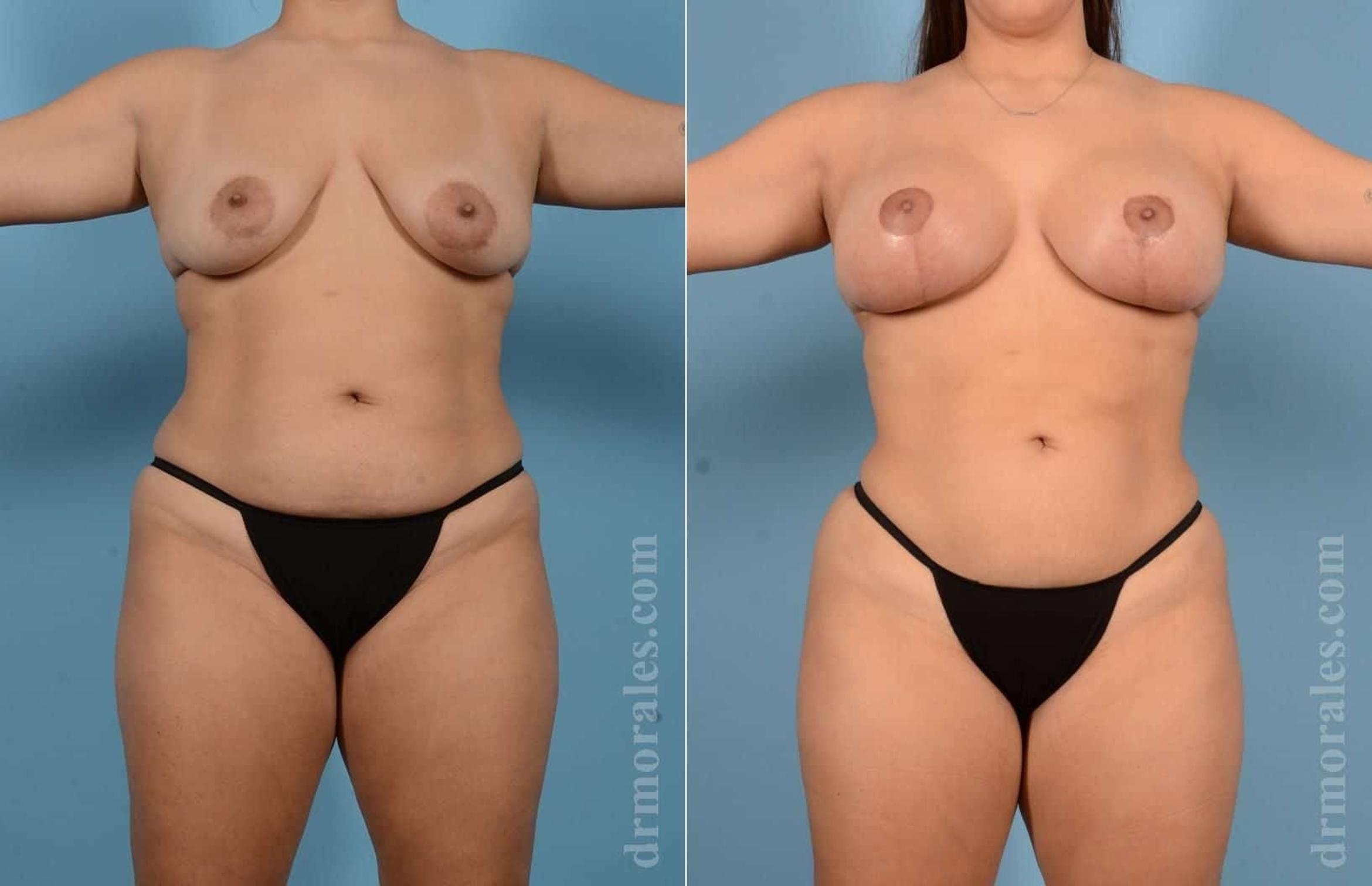 Before & After Mommy Makeover Case 58 View 1 View in Houston, TX