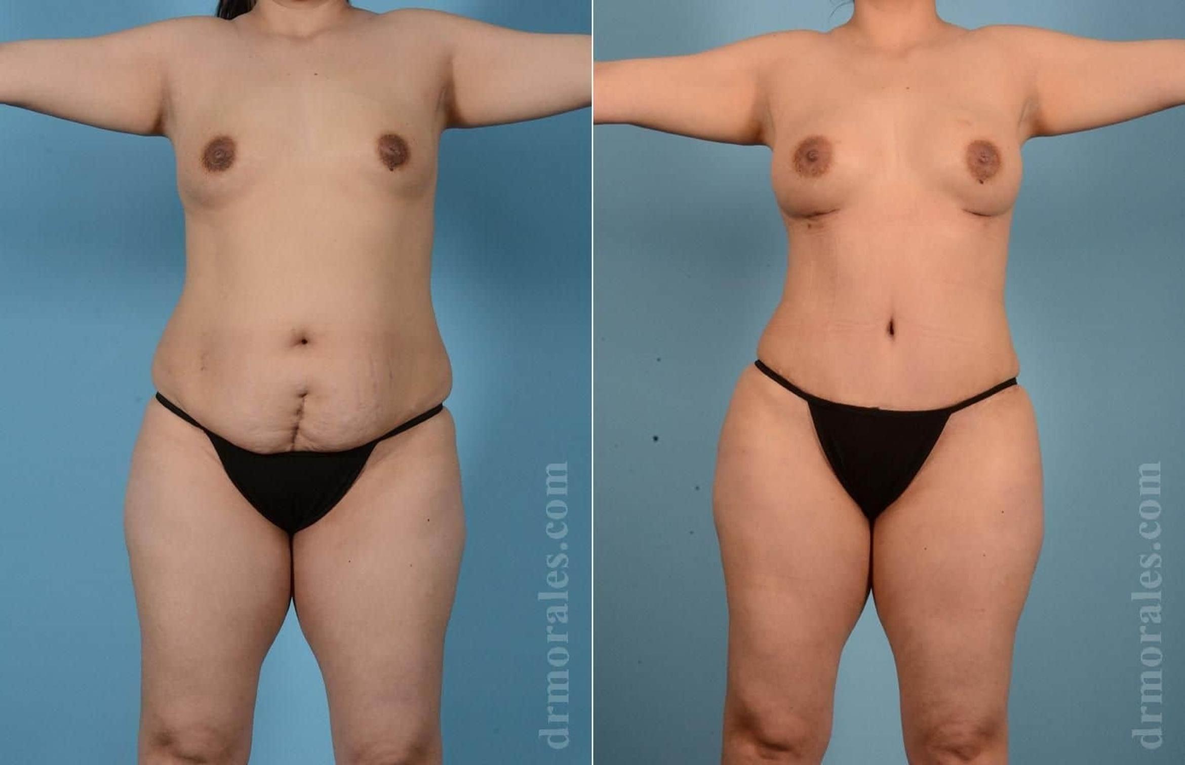 Before & After Mommy Makeover Case 59 View 1 View in Houston, TX