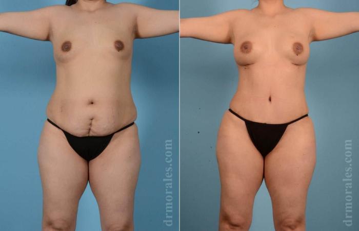 Before & After Mommy Makeover Case 59 View 1 View in Houston, TX