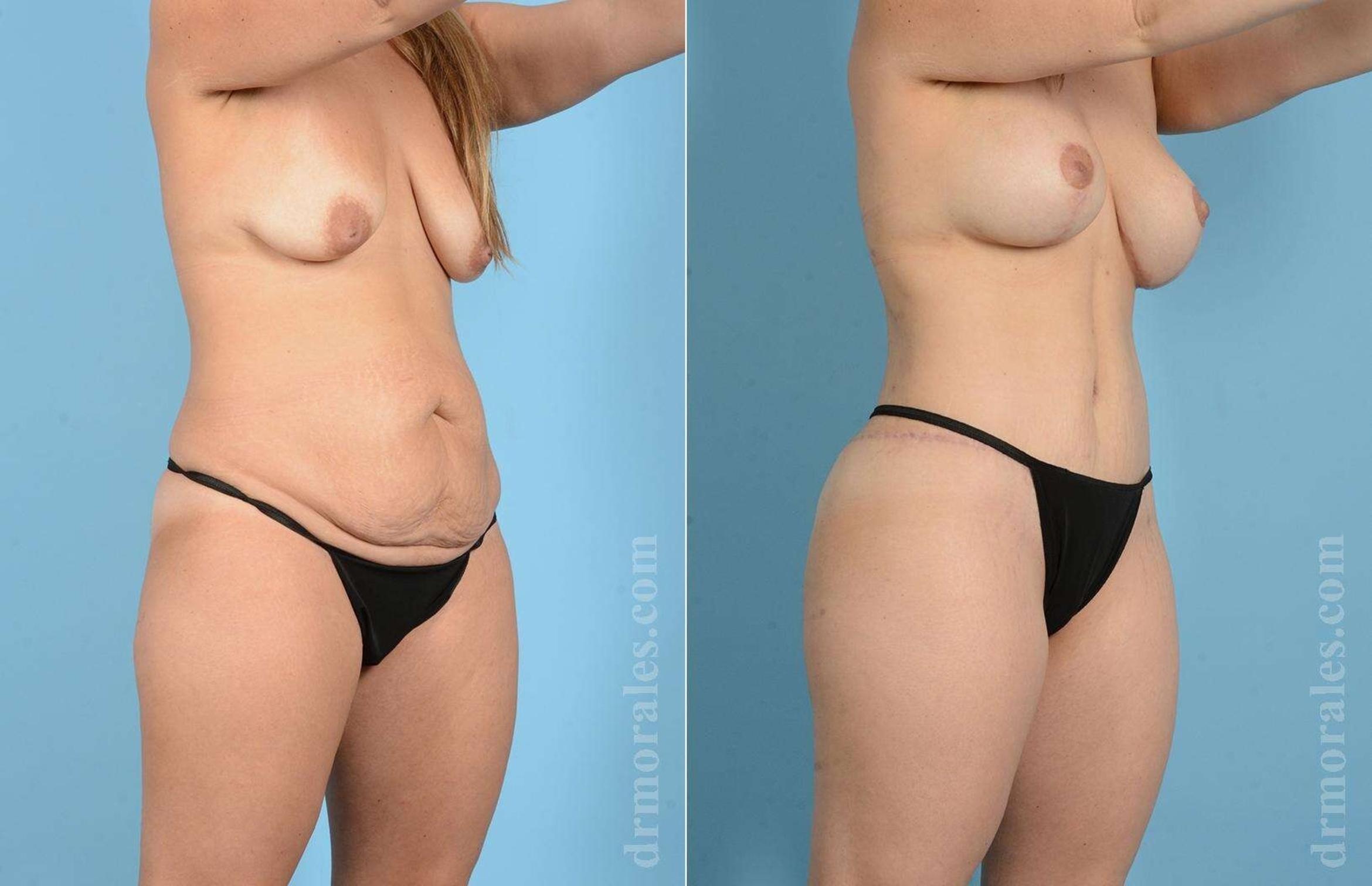 Before & After Mommy Makeover Case 6 View 1 View in Houston, TX