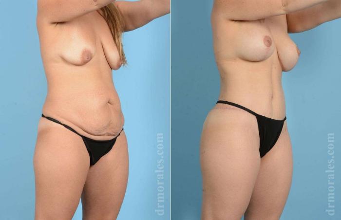 Before & After Mommy Makeover Case 6 View 1 View in Houston, TX